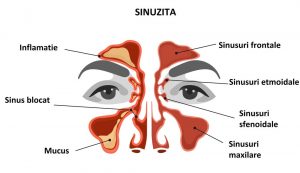 sinuzita poze