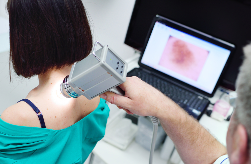 dermatoscop - Totul despre alunite (nevi): cauze, complicatii, tratament